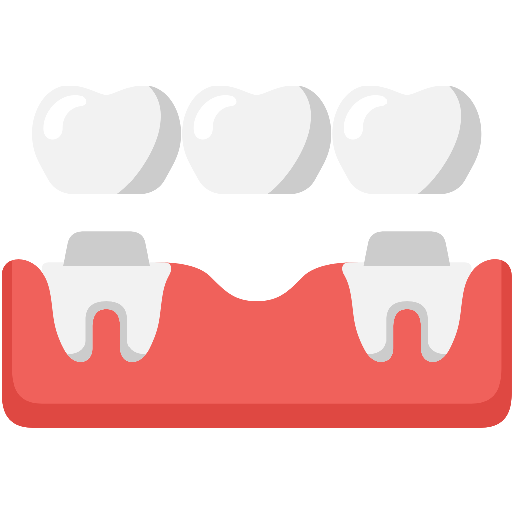 Dental Bridges