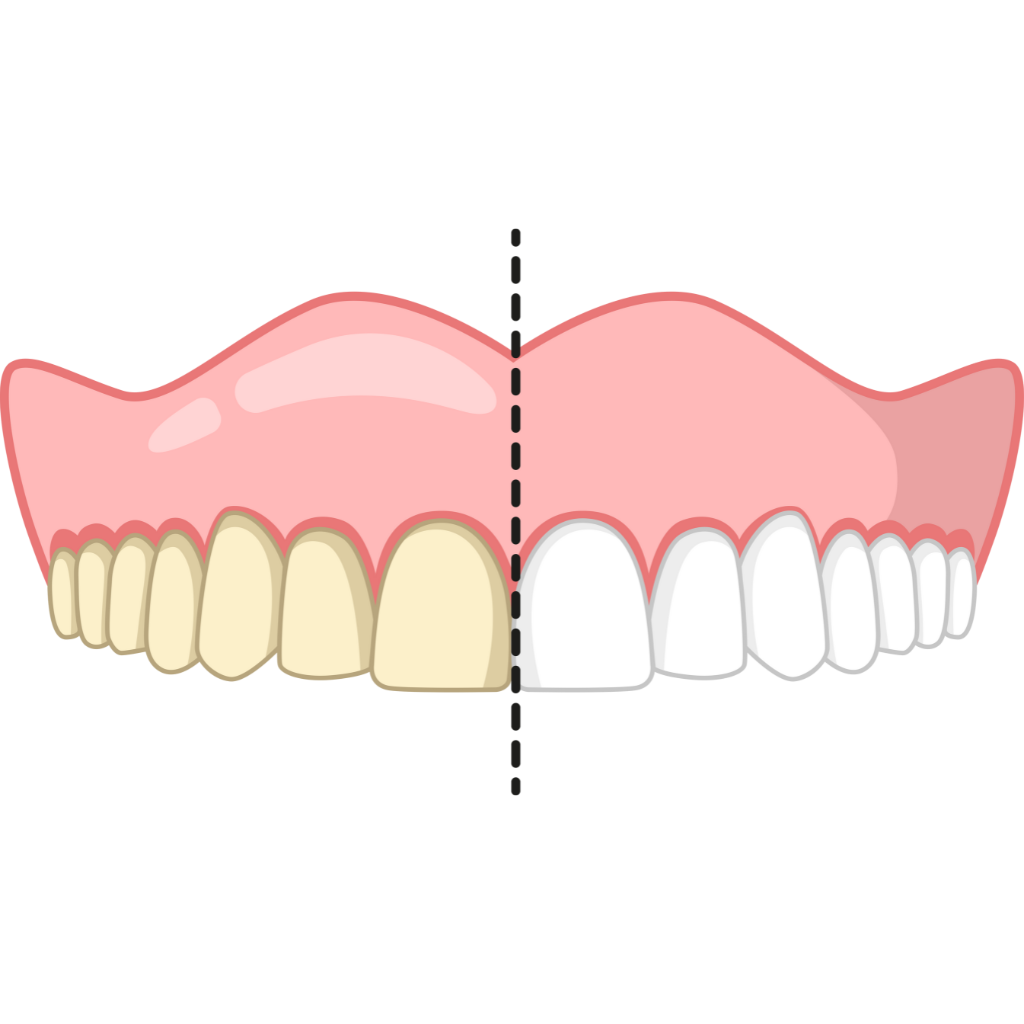 Teeth Whitening