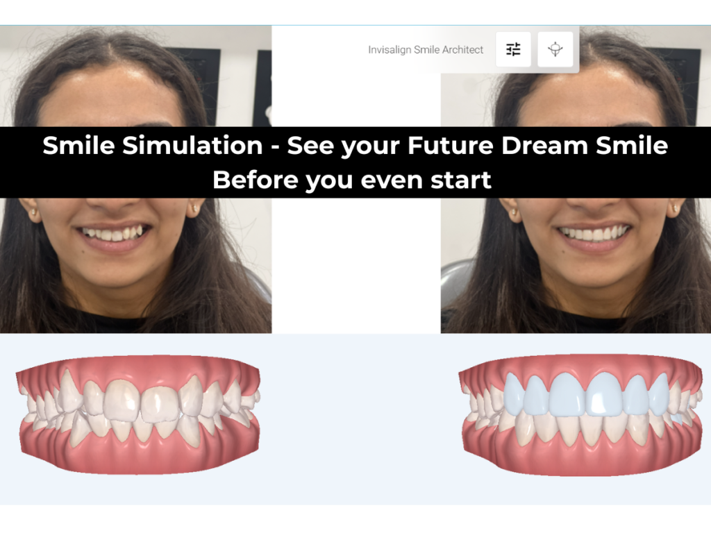 invisalign smile architect showing smile simulation with veneers after scanning for better patient knowledge on how their future smile will look on their face before even starting the treatment building trust and authority amongst them.